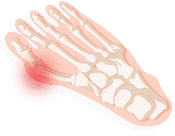 burning pain in side of heel