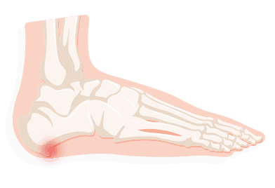 sharp pain in heel and side of foot